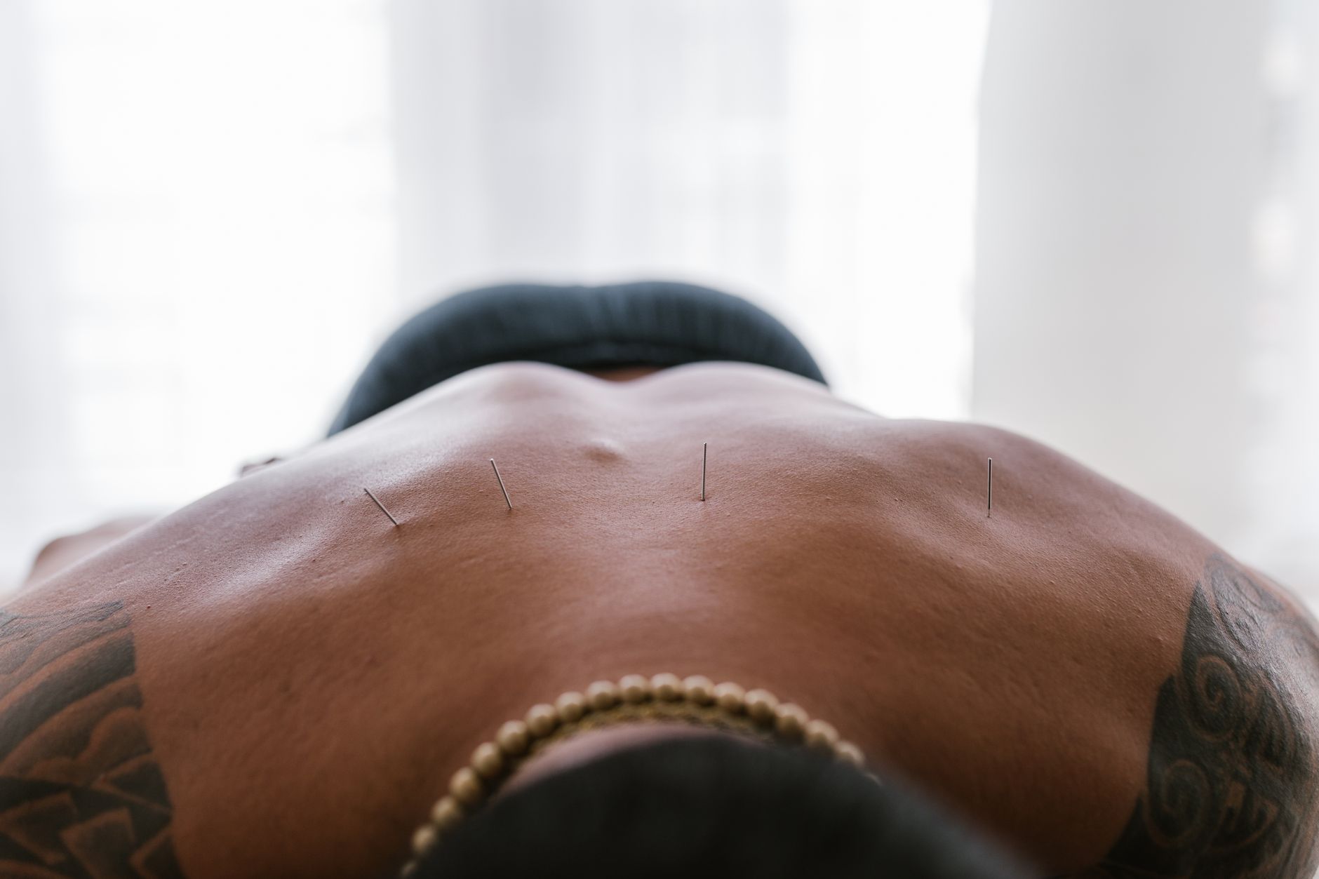 Acupuncture needles applied to a person's back during treatment